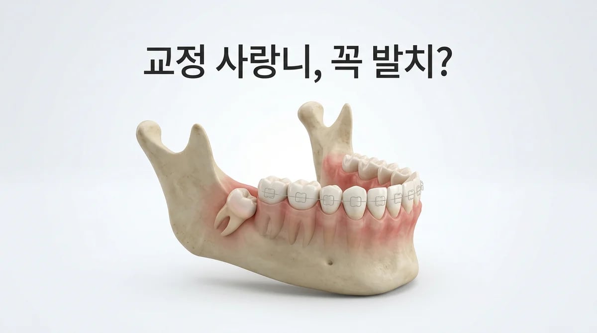 치아교정 시 사랑니 발치, 꼭 필요할까? 3가지 핵심 기준