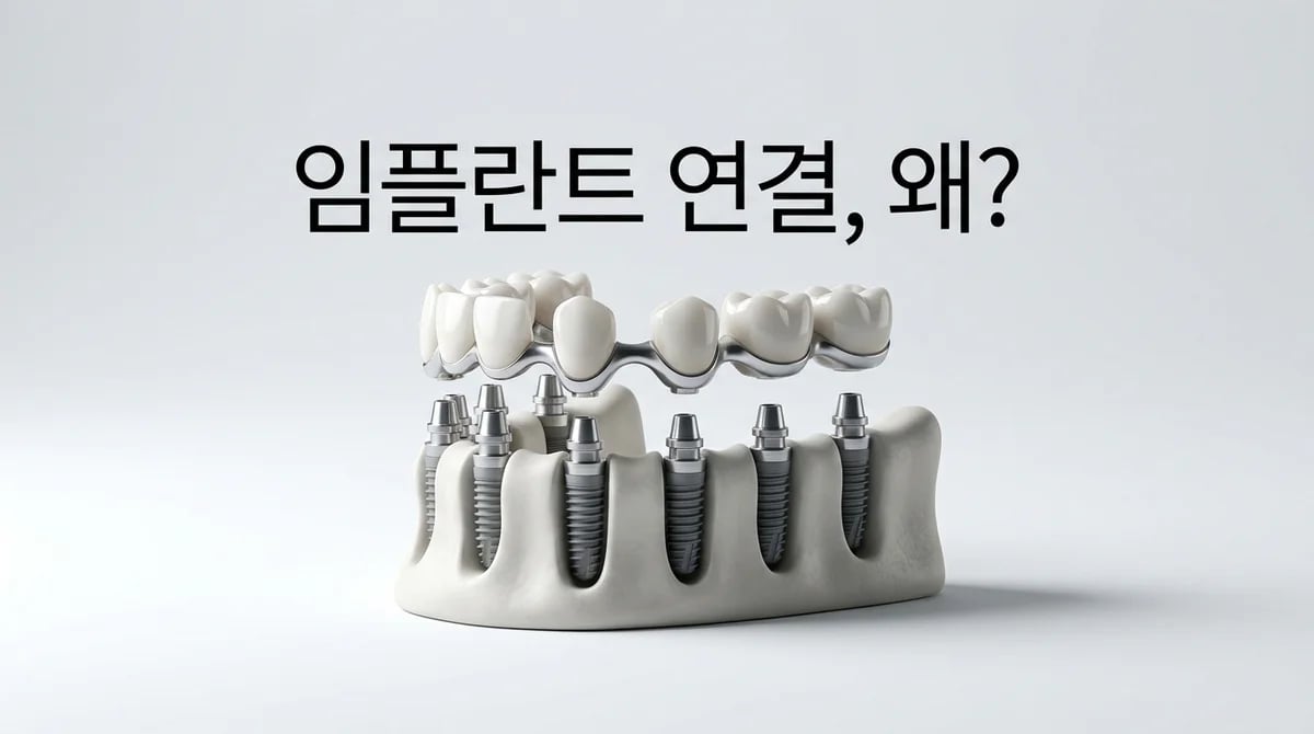 임플란트 크라운 연결(Splinting)의 공학적 원리와 장점
