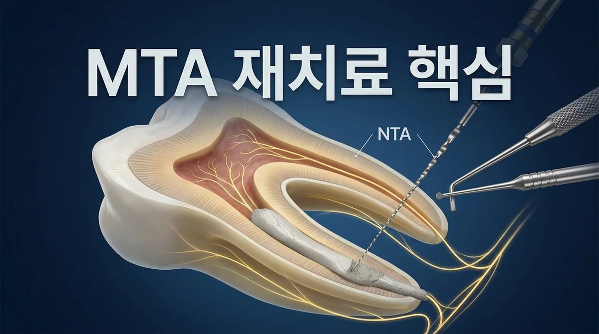 MTA 신경치료 후 재치료, 성공률 높이는 3가지 핵심 정보