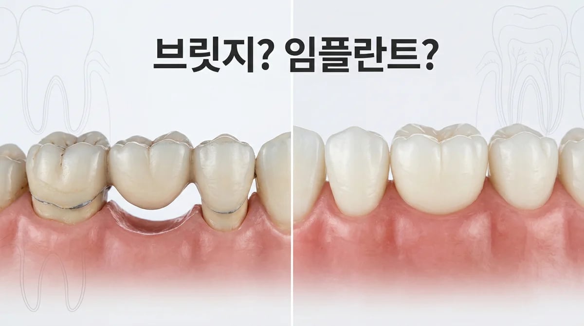 오래된 브릿지 교체: 임플란트 vs 새 브릿지, 현명한 치료 선택 가이드