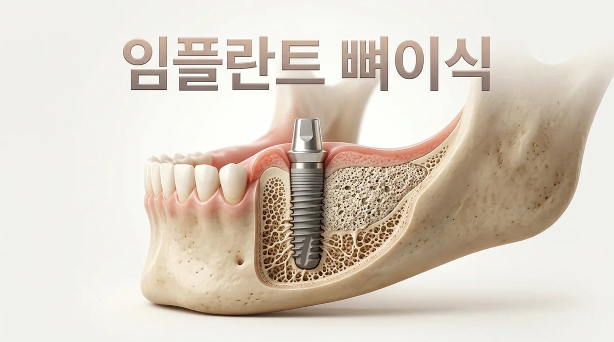 임플란트 뼈이식, 성공적인 식립을 위한 4가지 재료와 과정 이해