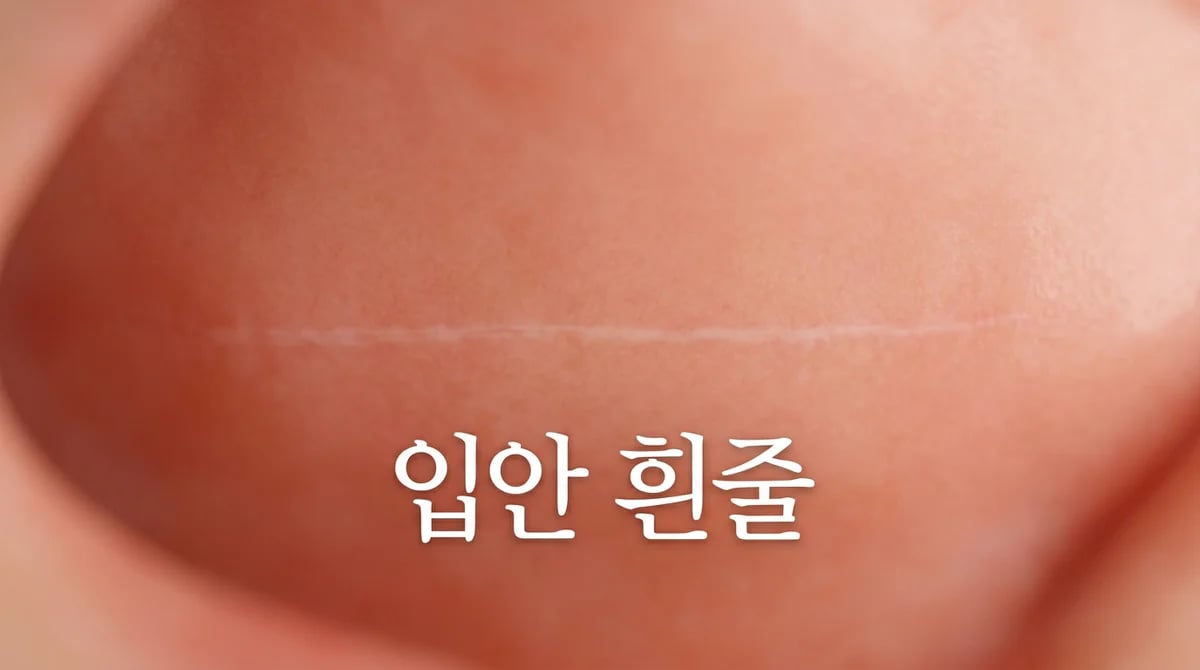 볼 안쪽 흰 선, 입안에 생긴 흰줄의 5가지 의미와 원인 분석