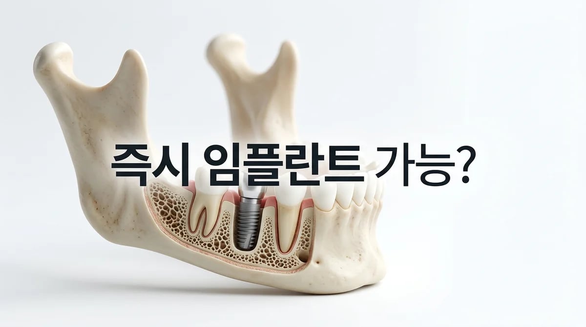 발치즉시 임플란트, 성공을 위한 핵심 조건 2가지와 가능 여부