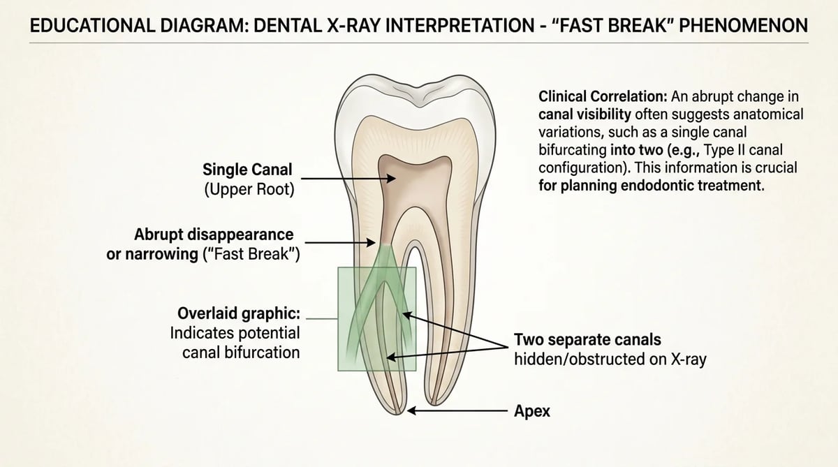 근관이 갑자기 사라지는 것처럼 보이는 Fast Break 현상을 설명하는 치아 X-ray 판독 도식