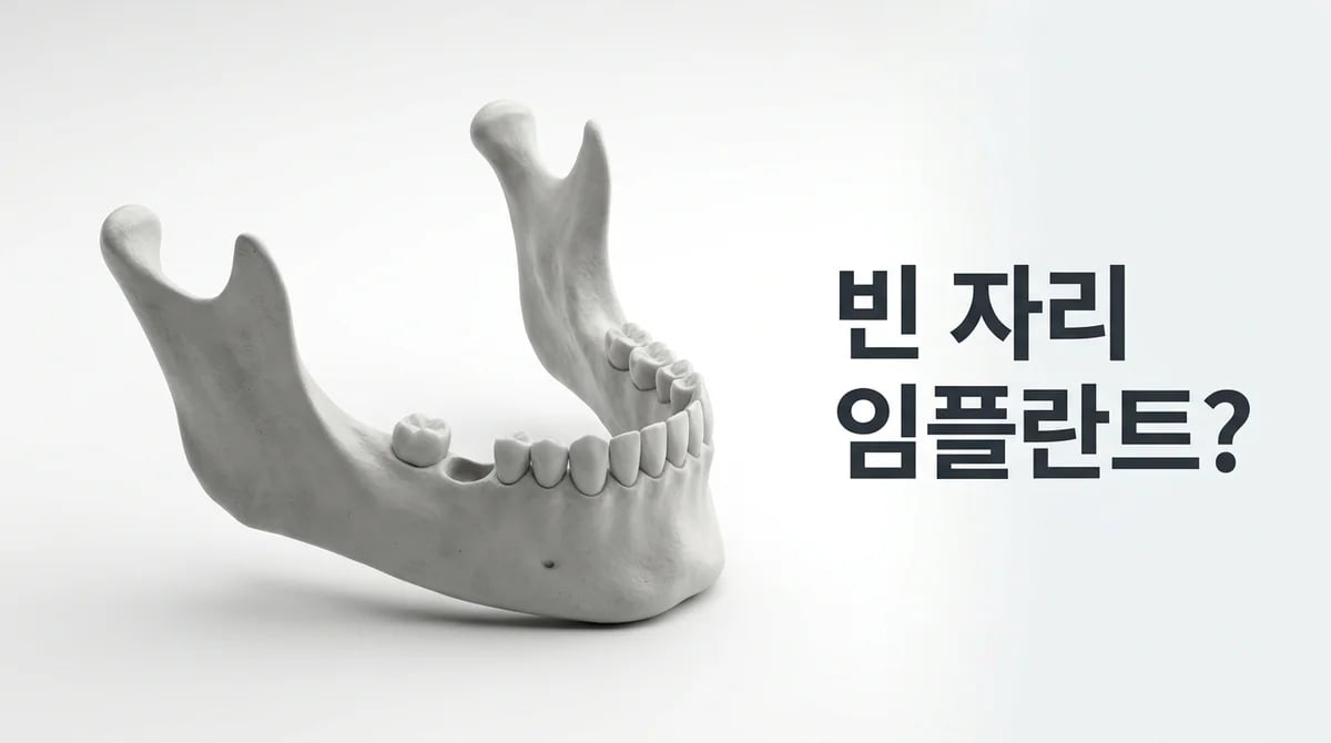 발치 없이 임플란트 식립 가능할까? 치아가 없던 자리 핵심 조건과 진단
