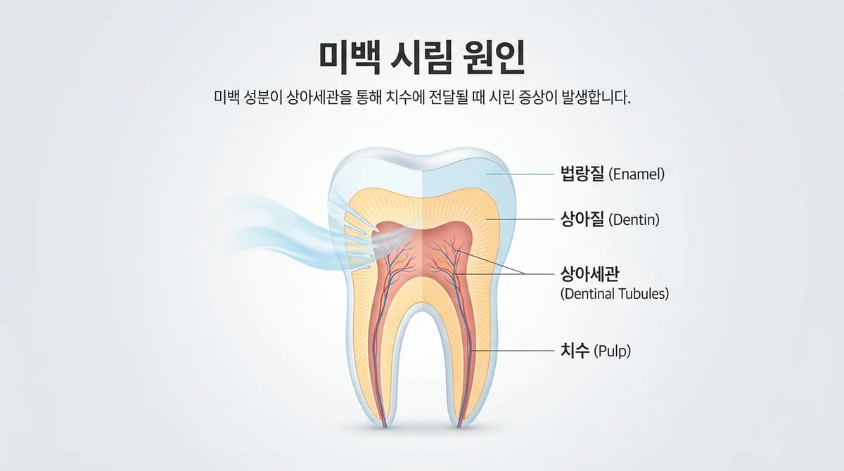 치아 미백 후 시린 이, 상아질 지각과민증 원인과 관리법