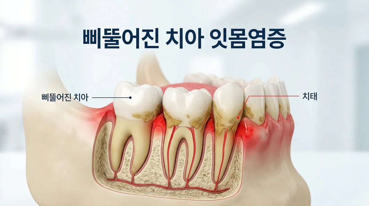 고르지 못한 치열과 잇몸 염증, 원인 분석 및 3단계 관리법
