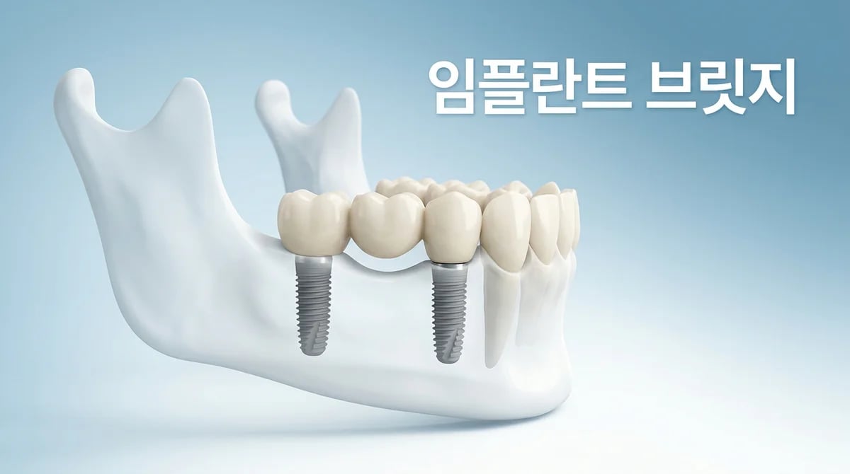 여러 치아 상실 시 임플란트 브릿지: 과학적 원리 및 고려사항