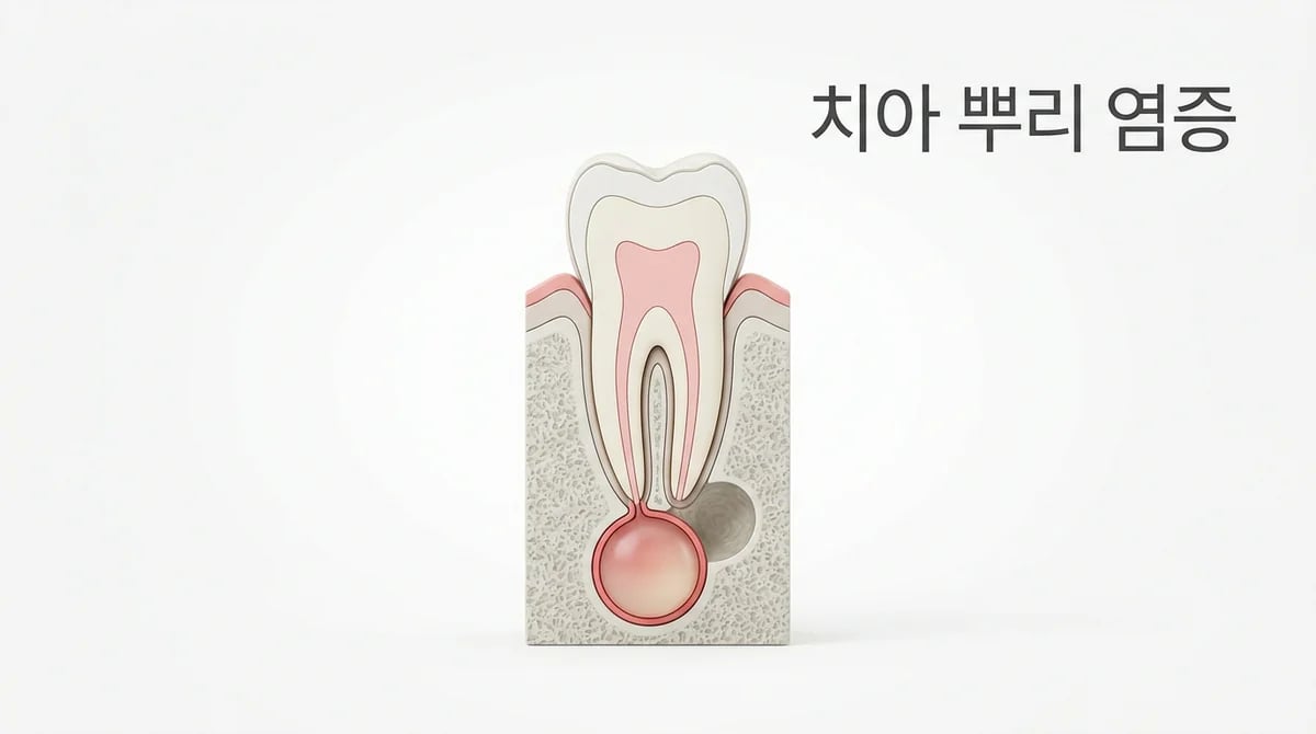 치근단낭: 치아 뿌리 염증의 원인, 증상, 치료 방법 완벽 가이드