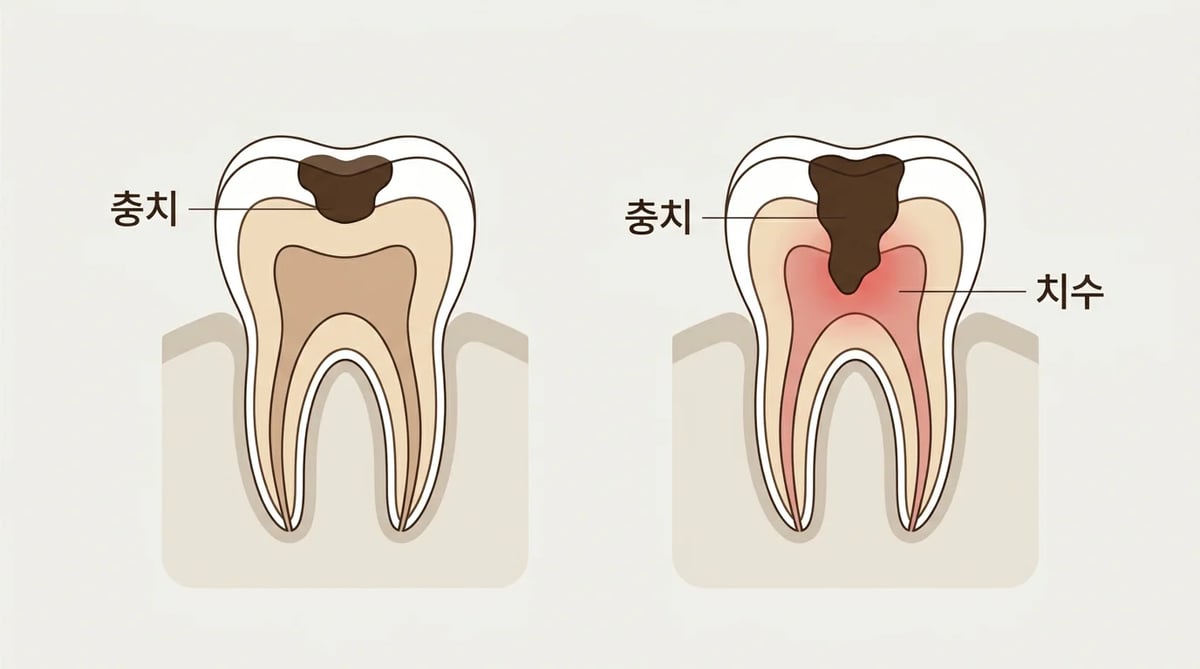 단순 충치와 신경까지 진행된 충치 치아 단면도 비교