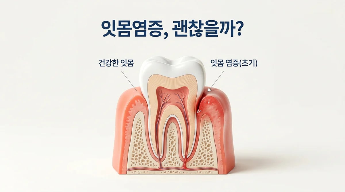 경미한 잇몸 염증: 자연 회복 가능성 및 2주 자가 관리법 가이드