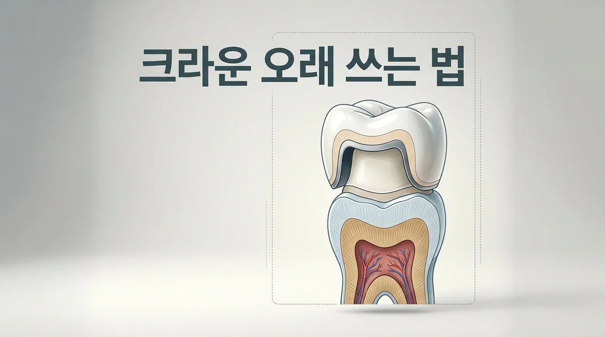 크라운 치아 10년 이상 사용 가이드: 2차 충치 예방과 관리법