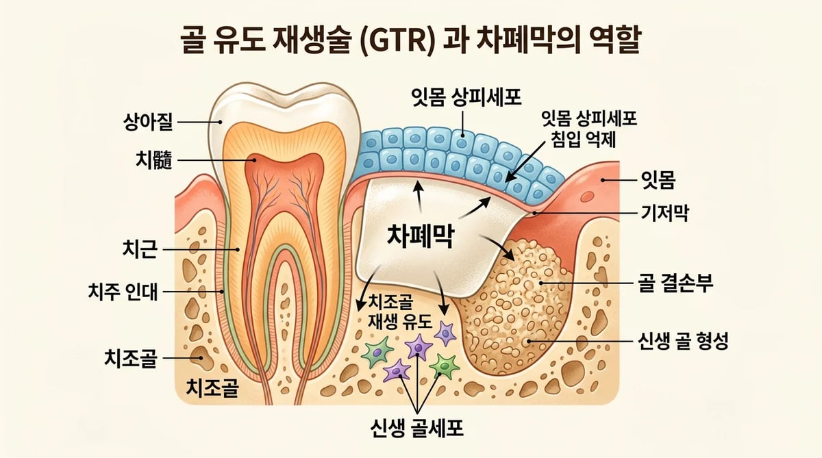 치주골 재생 치료에서 차폐막을 이용한 조직유도재생술(GTR)의 원리 인포그래픽