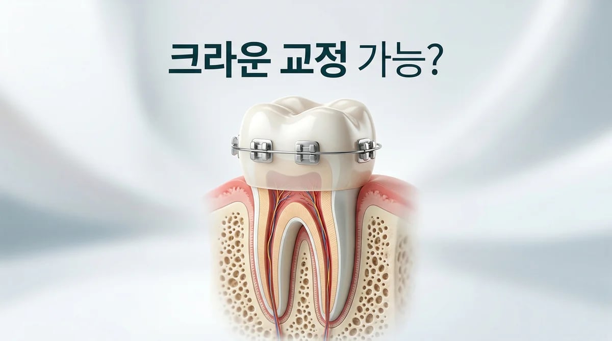 크라운 씌운 치아 교정 가능할까? 핵심 고려사항 3가지