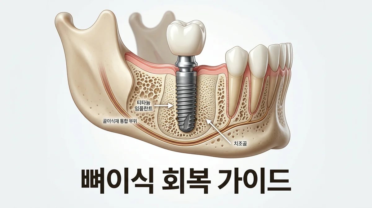 치과 뼈이식 수술: 성공적인 회복을 위한 3단계 기간별 관리 가이드