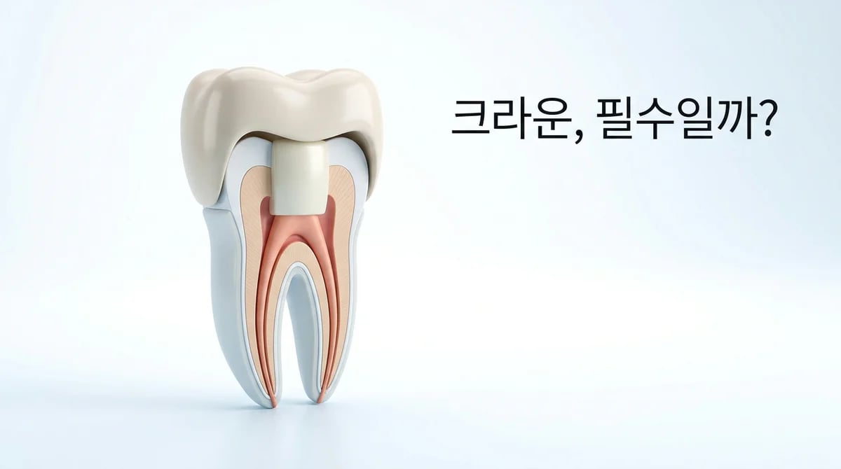 신경치료 후 크라운, 치아 수명 2배 늘리는 비밀? 장기 생존율의 과학