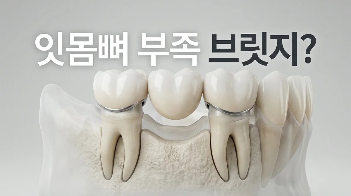 치아 브릿지, 잇몸뼈 부족 시 성공 조건 2가지 심층 분석