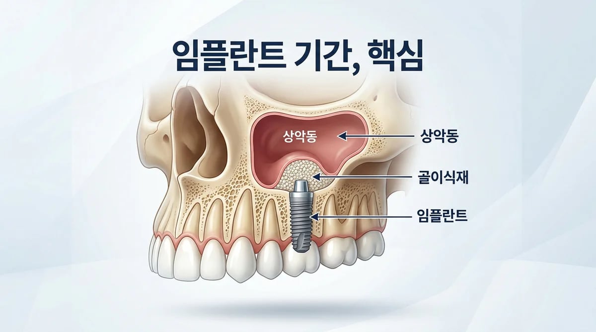 상악동 거상술 동반 임플란트, 치료 기간 결정 핵심 요소와 두 가지 시나리오