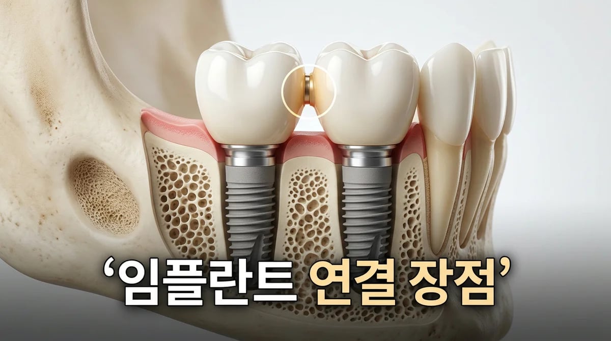 인접 임플란트 크라운: 스플린트 방식이 장기 안정성을 높이는 이유