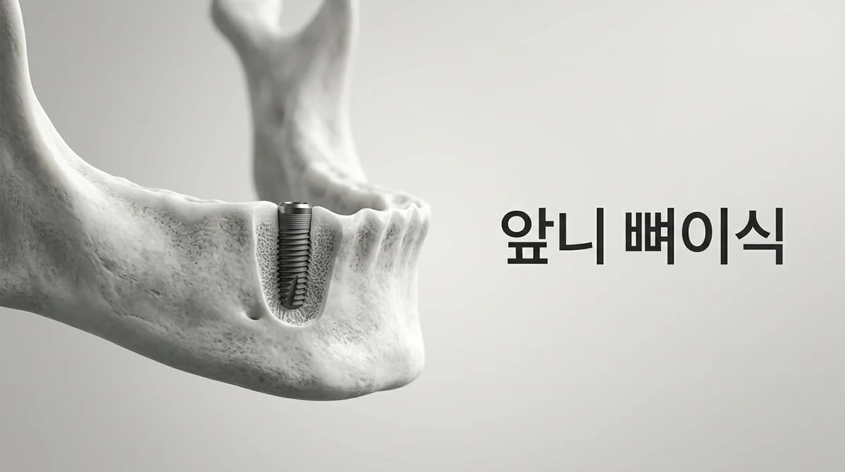 앞니 임플란트 뼈이식의 중요성: 고려사항 및 비용 정보