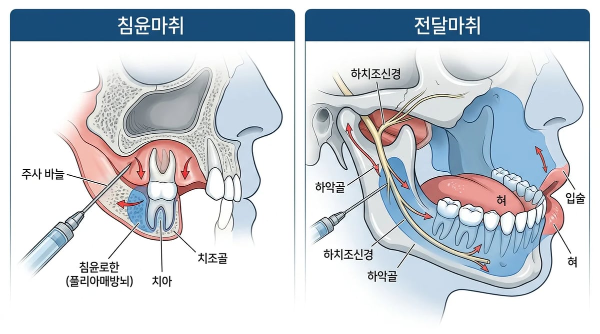 침윤마취와 전달마취의 주입 부위 및 마취 범위 차이를 보여주는 치과 해부학적 일러스트.
