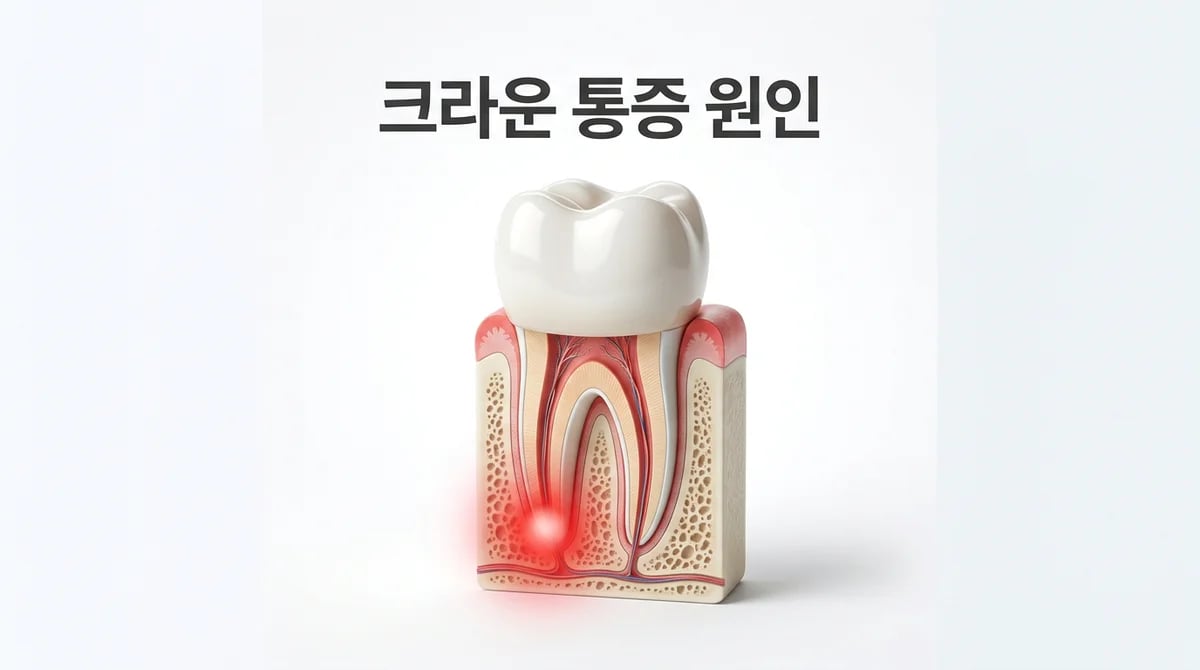 신경치료 후 크라운 통증, 왜 생길까요? 원인과 대처법 5가지