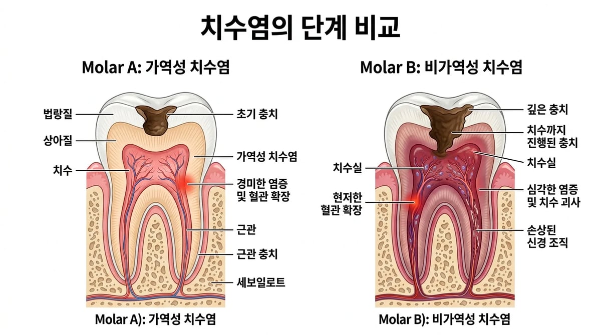 가역성 치수염과 비가역성 치수염의 진행 단계를 보여주는 비교 다이어그램
