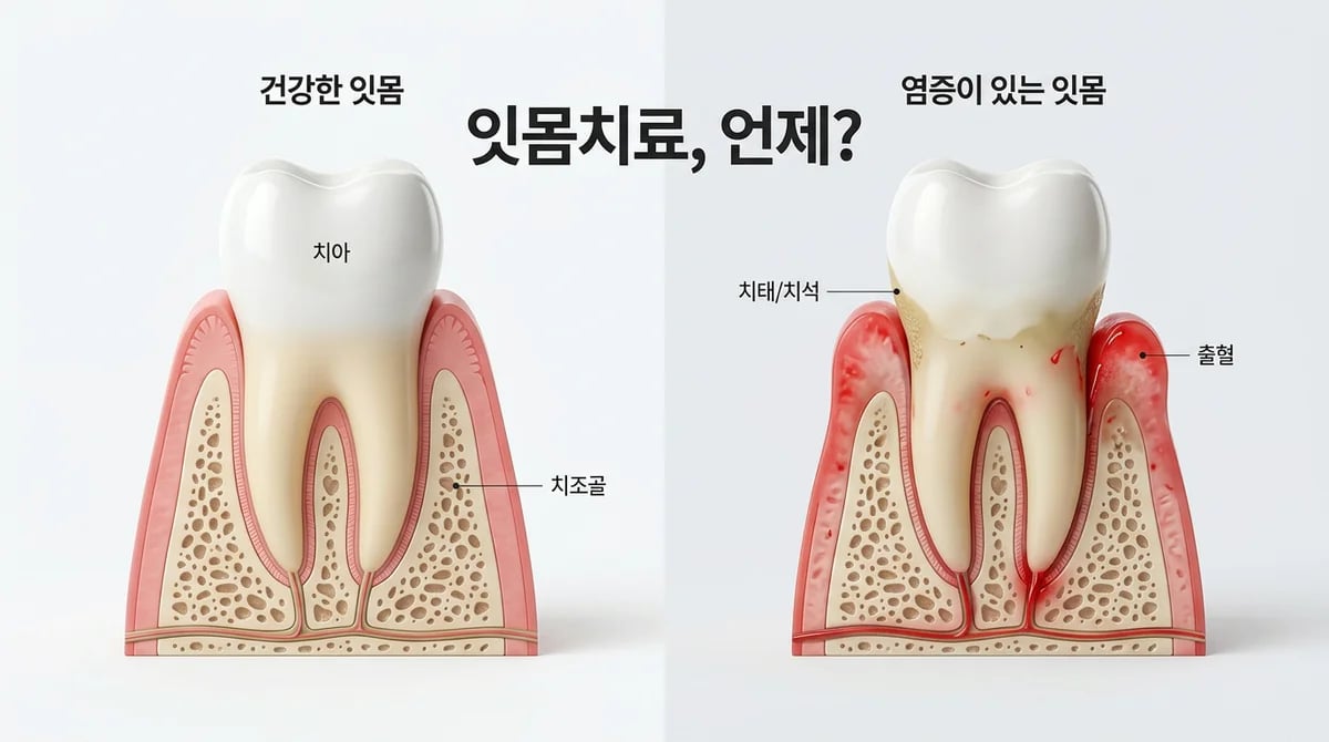 잇몸치료, 언제 필요할까? 치은염·치주염 증상과 관리 가이드