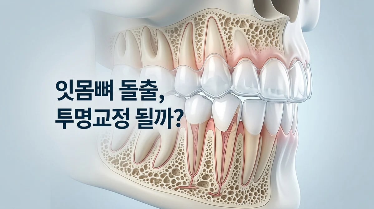 잇몸뼈 돌출 교정, 투명교정만으로 가능할까요? 비수술 치료의 한계 분석