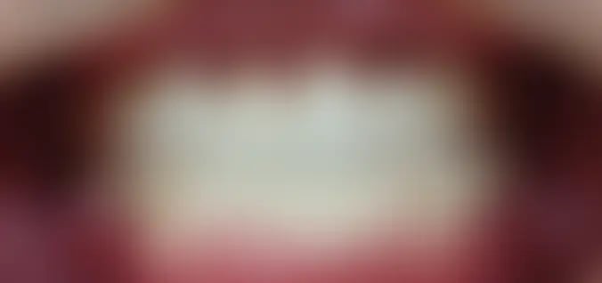 치료 후 — 크라운을 씌운 윗앞니가 아랫니를 덮으며 맞물린다 (로그인하면 보입니다)