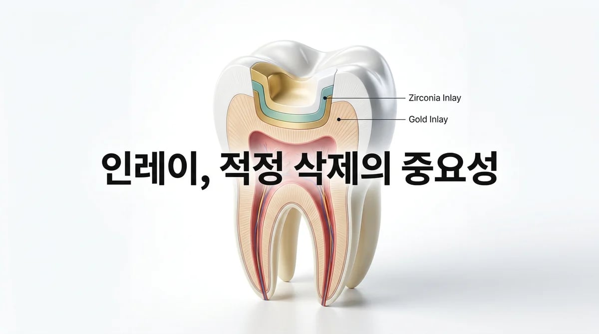 인레이 치료, 지르코니아와 금: 적정 치아 삭제량과 재료별 특징 비교