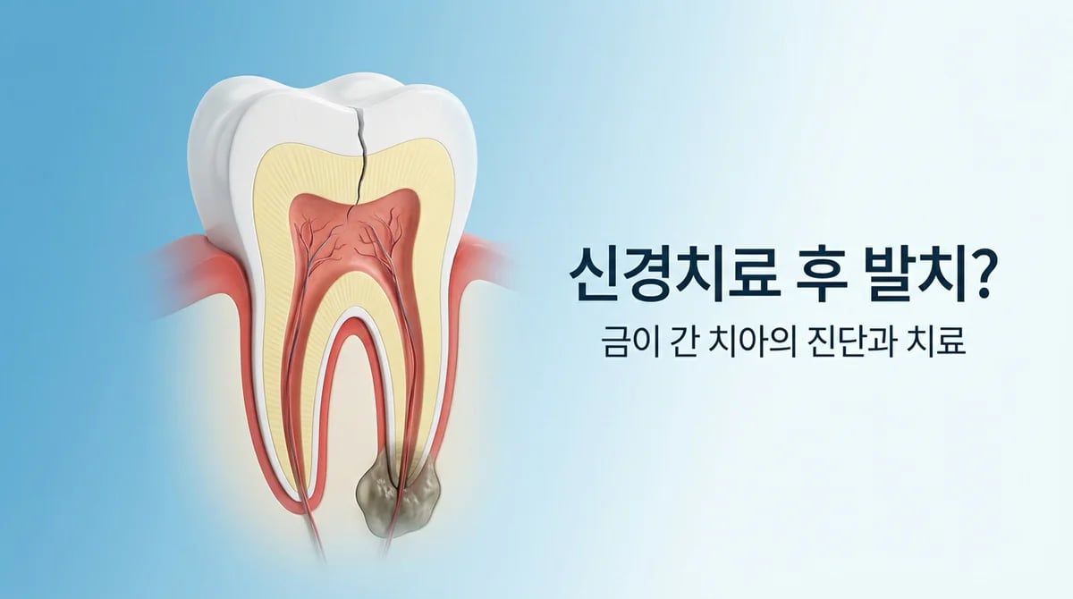 신경치료 후 발치와 임플란트가 필요한 5가지 이유와 진단 가이드