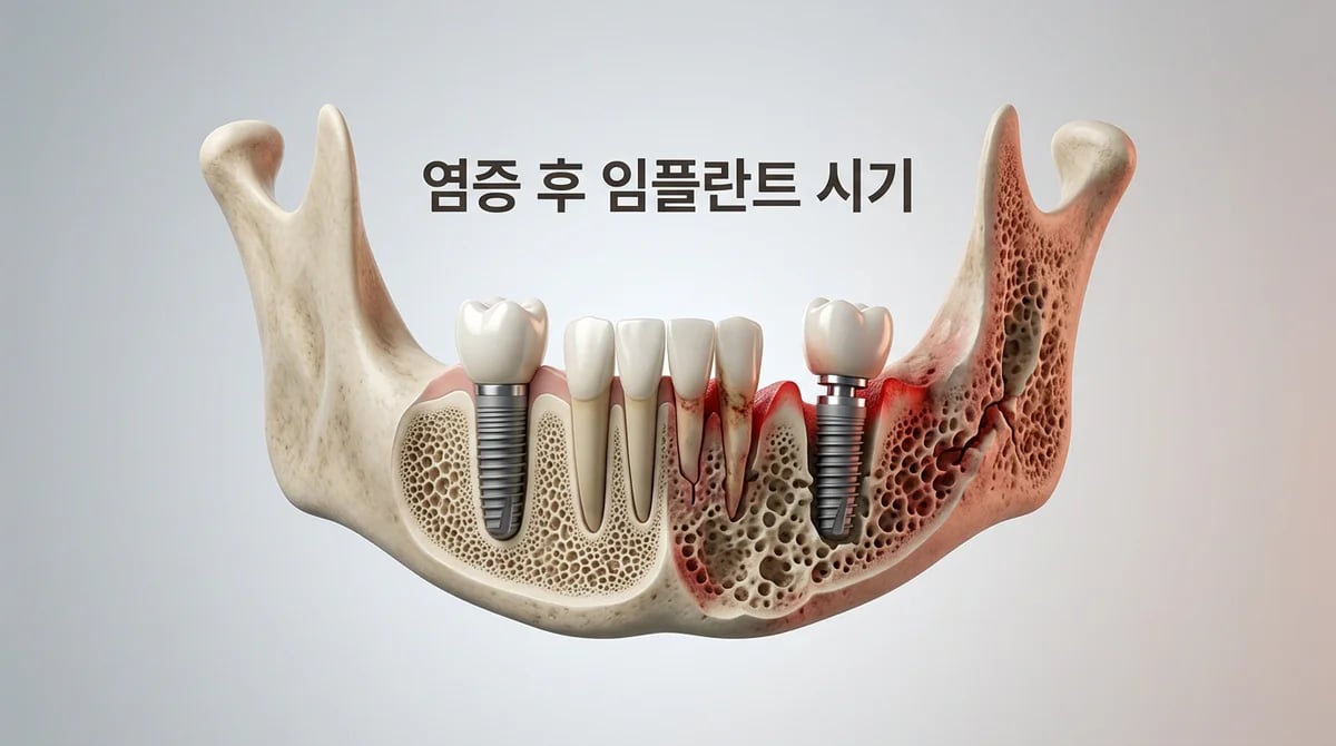 잇몸 염증 후 임플란트, 언제 심는 것이 좋을까? 성공률 높이는 고려사항