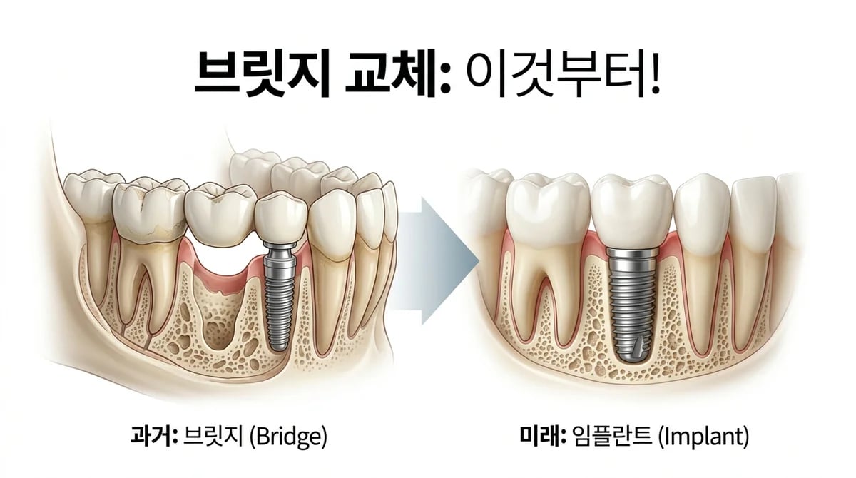 오래된 브릿지를 임플란트로 교체, 성공을 위한 핵심 고려사항