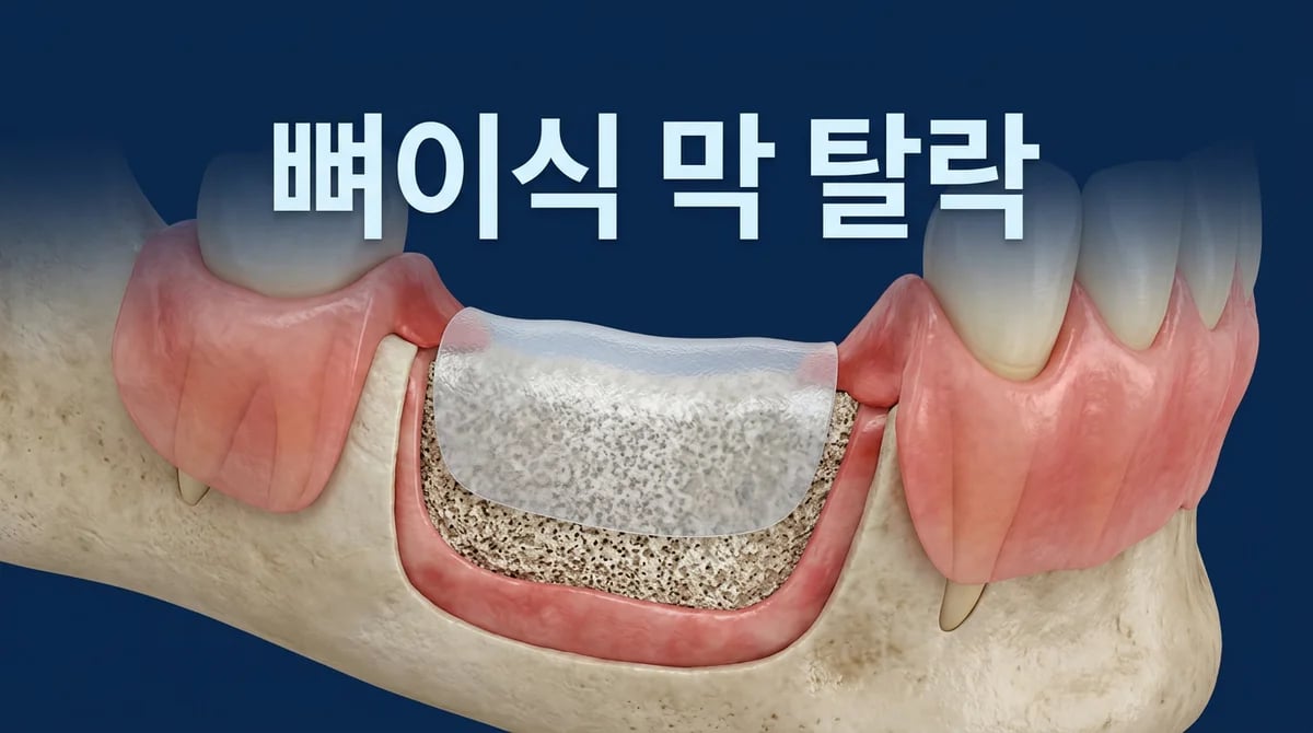 임플란트 뼈이식 후 차폐막 노출·탈락 시 대처: 유형별 가이드