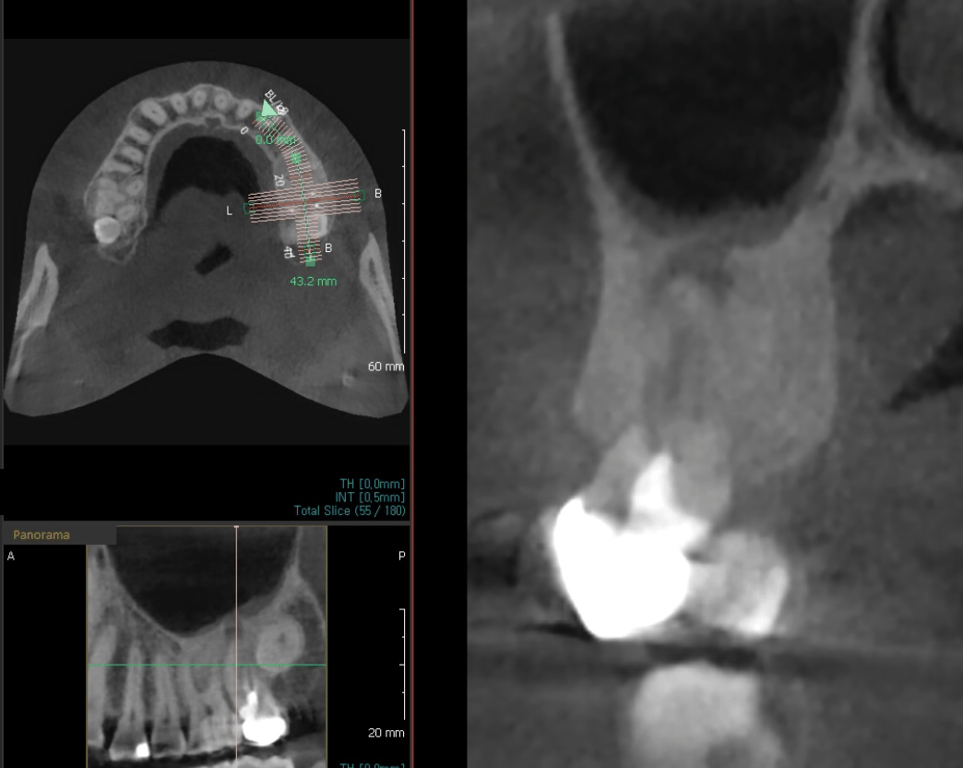 위 어금니 부위 CBCT 단면 영상