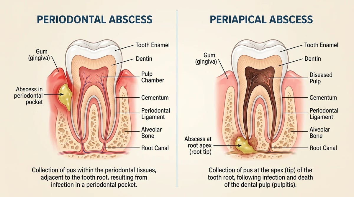 치주농양과 치근단농양의 발생 원인과 위치 비교 일러스트