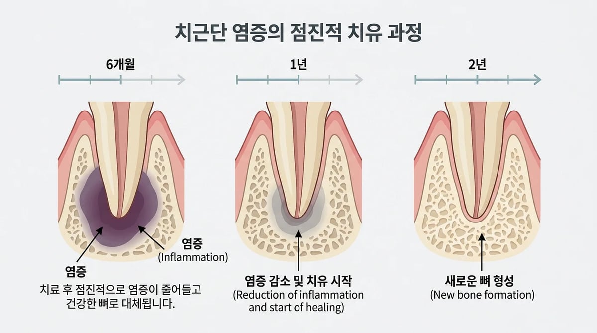 치아 뿌리 염증이 새 뼈로 치유되는 단계별 과정과 시간 흐름