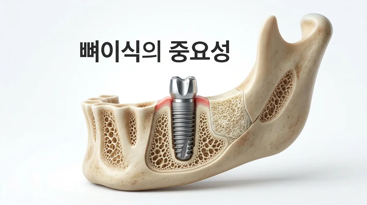 임플란트 성공률 높이는 뼈이식, 왜 중요할까? 필수 조건 3가지
