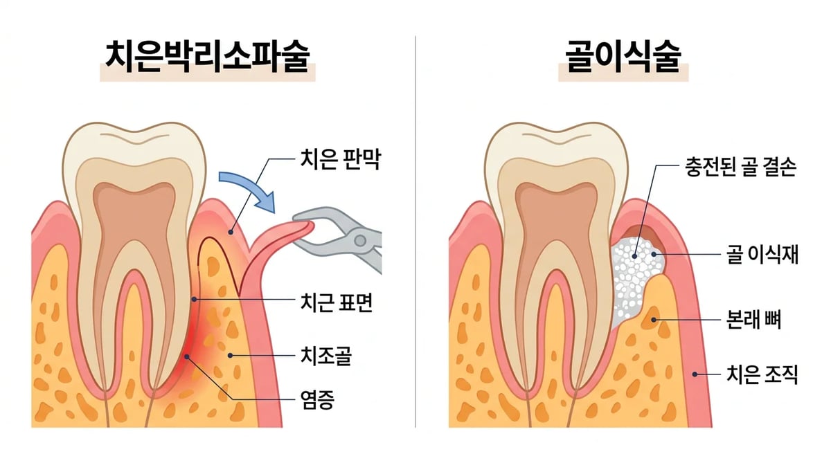 치은박리소파술과 골이식술의 개념을 보여주는 간략한 의료 도식