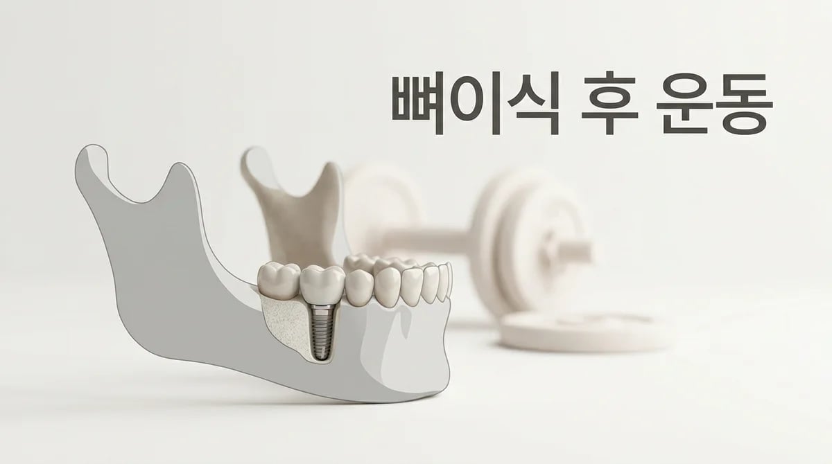 치과 뼈이식 후 헬스 안전 가이드: 4단계 운동 재개 프로토콜