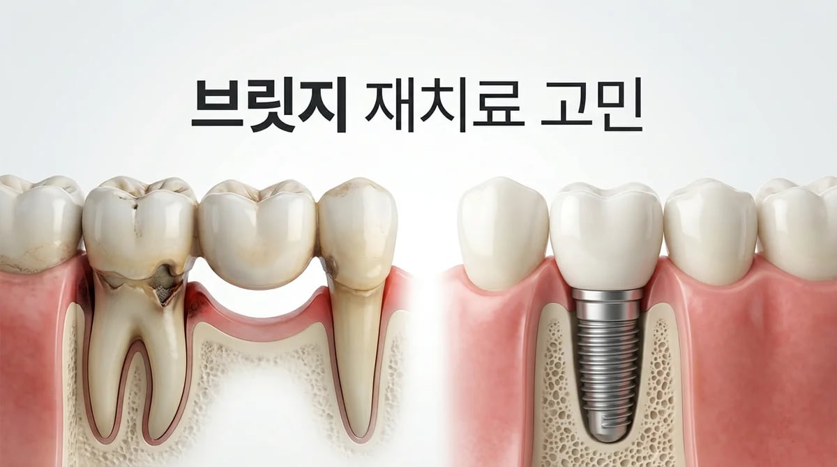 오래된 브릿지 지지치아 문제: 3가지 위험 신호와 임플란트 재치료 가이드