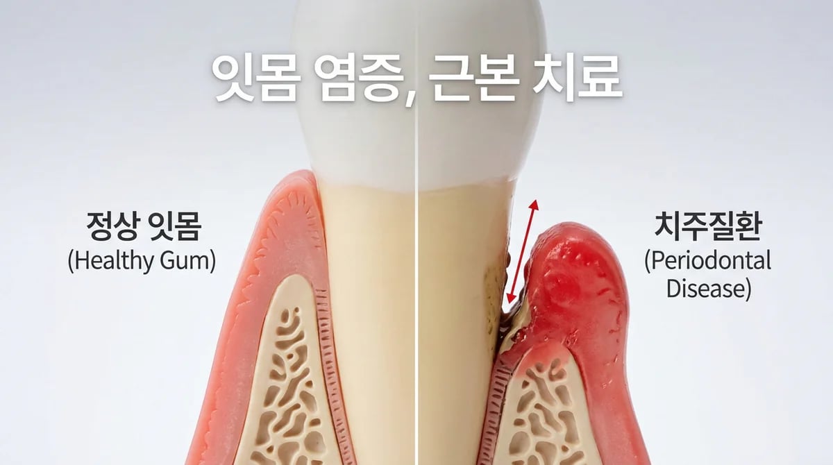 치주수술: 잇몸 염증과 치석을 근본적으로 제거하는 과정과 중요성