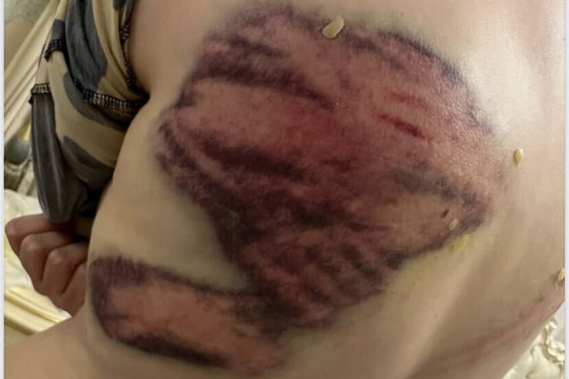 Следы побоев на теле Алии после побоев её брата. Фото:  СК SOS