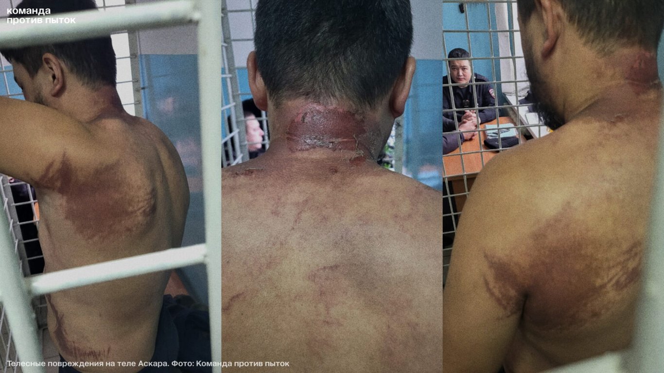 Следы от пыток на теле Аскара. Фото: «Команда против пыток»