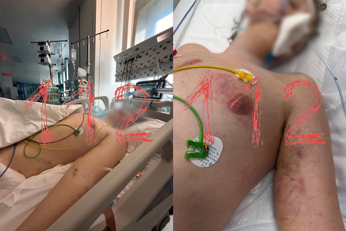 Следы побоев на теле Романа после пребывания в реабилитационном центре. Фото:  «112»