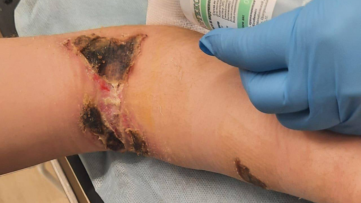 Руки Виктории после того, как ее привязали к батарее в изоляторе, 2023 год. Фото предоставлено Антоном Чельцовым