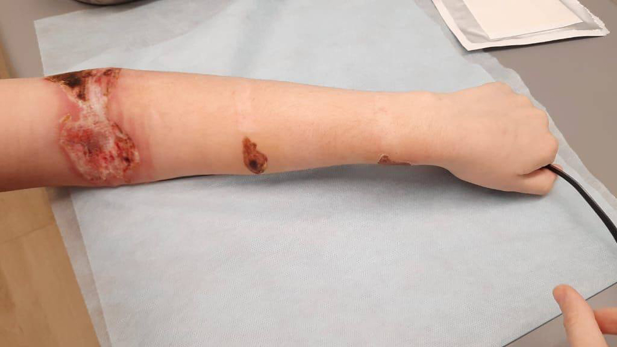 Руки Виктории после того, как ее привязали к батарее в изоляторе, 2023 год. Фото предоставлено Антоном Чельцовым