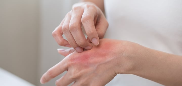 מרפאת אלרגיה הדסה עין כרם