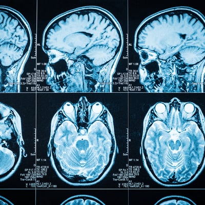 Neurological disorders